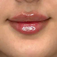 تزریق فیلر و بوتاکس