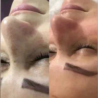فیشیال پاکسازی/پلاژن/میکرودرم/کربوکسی/تیرگی چشم