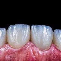 دندانپزشکی/عصب کشی/کامپوزیت/لمینت با تخفیف ویژه