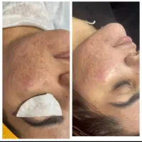 خدمات درمانی روشن کننده ورفع تیرگی پوست