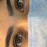 کاشت و ترمیم مژه