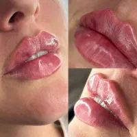 فیلروبوتاکس ومزوتراپی ومزوژل ها ب صورت تضمینی