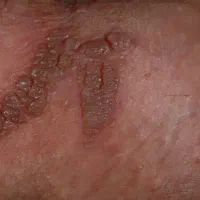 برداشت زگیل تناسلی و خال