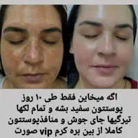کرم سفید کننده،ضد لک،ضد جوش صورت و دست و پا