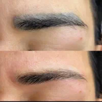 حذف انواع تتو و خالکوبی قدیمی با کیوسویچ
