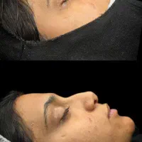 جراحی بینی به سبک seg