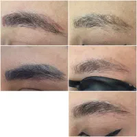 پاک کردن تتو۵۰۰/لیزر موهای زائد/الکترولیز/فیشیال