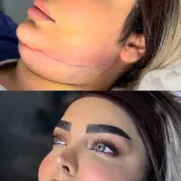 پول یه عمل بده دو تا ساکشن غبغب انجام بده