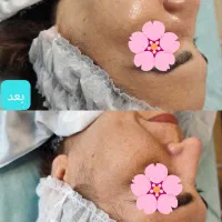 فیشال و پاکسازی صورت