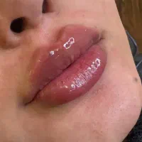 تخفیف ویژه بوتاکس و فیلر