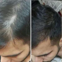 تونیک تخصصی ریزش مو/رویش مجدد