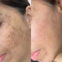 بیوممتیک ضدلک و ضدجوش