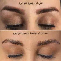 میکروبلیدینگ وریموورشت حمیدیان