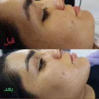 پاکسازی فیشال مزونیدلینگ مزوام دی اسکراب اسکالپ