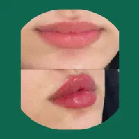 اموزش ژل بوتاکس مزوفیشال نخ لیزرجالپرو پروفایلو