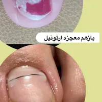 درمان ناخن فرو رفته در گوشت بدون جراحی|خدمات آرایشگری و زیبایی|مشهد, رستگار|دیوار