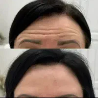 بوتاکس چشم گربه ای ، بوتاکس ضد عرق، بوتاکس میگرن