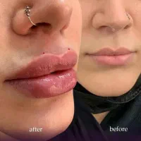 بوتاکس و تزریق ژل لیزر با پزشک در کلینیک
