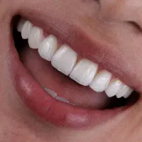 اقساطی /کامپوزیت/ لمینت و درمان