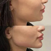 ژل وبوتاکس پی آر پی مزو و‌کاشت ابرو ومو