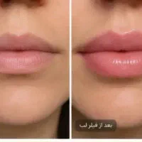 لیفت نخ مزو ژل و بوتاکس جوانساز
