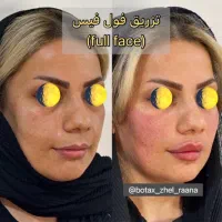 تزریق ژل و بوتاکس