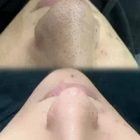جشنواره آف وایتینگ صورت و فیشیال