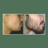 سرم تخصصی تراکم‌ساز