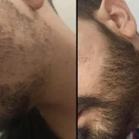 قوی ترین سرم رویش ریش