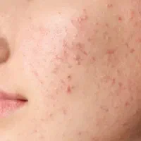 پک ضد جوش و جای جوس