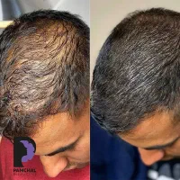 آخرین اقدام برای موهای پرپشت