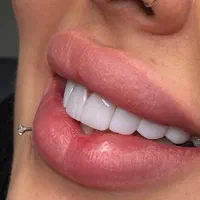 کامپوزیت ، لیرینگ لبه شیشه ای ، لمینت ،دندانپزشکی