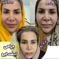 فیلر بادی، جراحی سرپایی زیبایی حجم دهی صورت بدن|خدمات آرایشگری و زیبایی|مرودشت, رودبال|دیوار