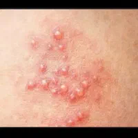 رفع قطعی و ریشه ای زگیل و تبخال تناسلی