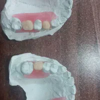 دندان مصنوعی وساخت انواع پروتز های متحرک