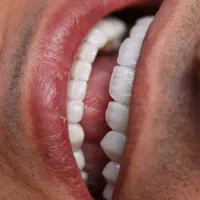 ایمپلنت دیجیتال