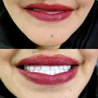 دندان مصنوعی، جوان پسند،سبک جدید، نسل جدید،اقساطی
