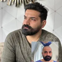 کاشت مو طبیعی