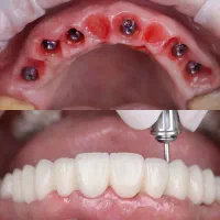 دندانپزشکی ایمپلنت تخصصی باشرایط اقساطی فقط۱۳ تومن