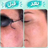 درمان لک،کک و مک(مایابیوتی)اولین مرکز کربن تراپی