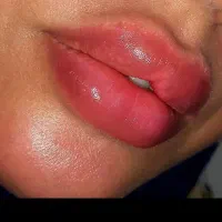 ژل وبوتاکس فیلر وانزیم.برداشتن خال پاک‌کردن تاتو