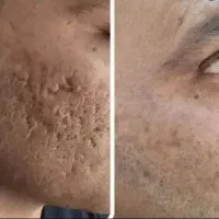 جشنواره درمان تضمینی اسکار/تورفتگی پوست فقط تافردا