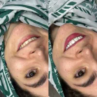 جشنواره کامپکزیت دندان