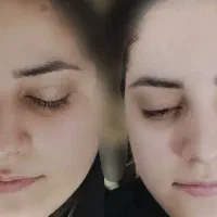 جشنواره تخفیفی پاکسازی با 8جلسه لیزر رایگان