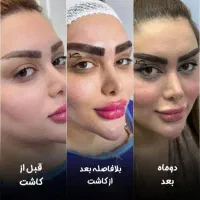 جشنواره میکرو کاشت ابرو ،کاشت مژه، آموزش تخصصی