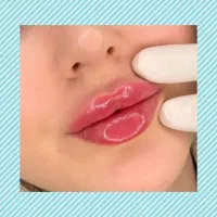 بوتاکس ژل لب پی آر پی لیزر آفر ۶۰ درصدی ویژه