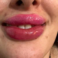 بوتاکس مصپورت ژل لب فیلر چشم۸۵۰