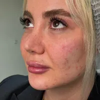 ژل زیرچشم شقیقه فیلر گودی چشم و شقیقه درمان گودی|خدمات آرایشگری و زیبایی|تهران, صادقیه|دیوار