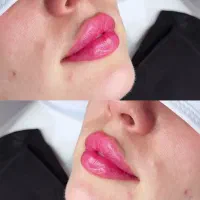 (PRP صورت و مو)فیلر و بوتاکس و تزریق چربی