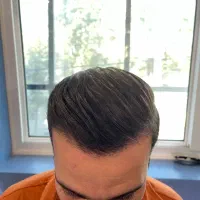 کاشت مو و ابرو طبیعی